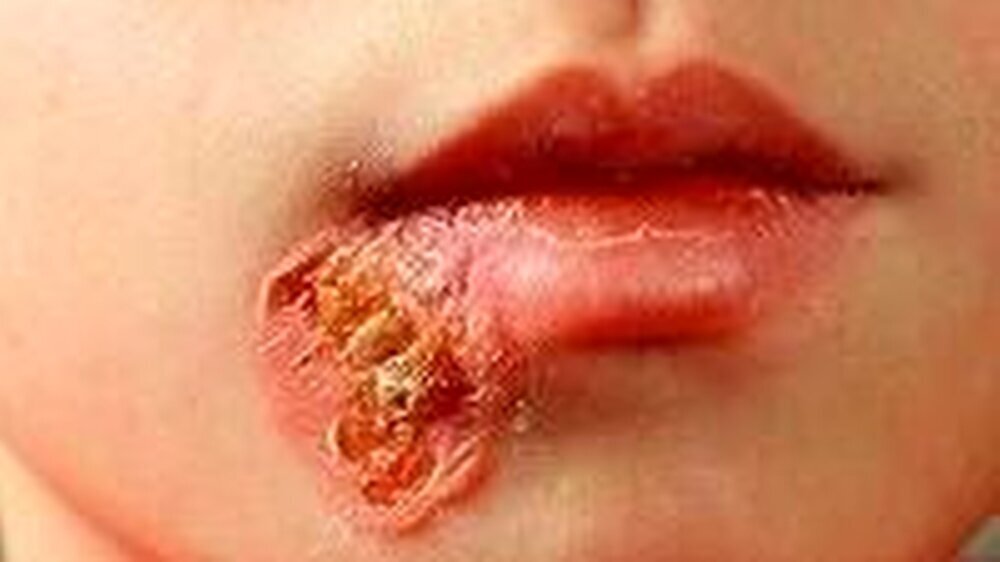 Honiggelbe Eiterkrusten sind typisch für eine Impetigo contaginosa, hier verursacht durch eine Infektion mit Streptococcus pyogenes.