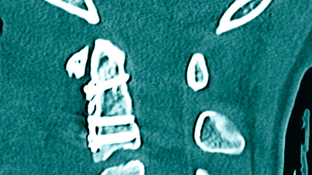 08.07.2016: In der postoperative CT-Kontrolle der zweiten durchgeführten Osteosynthese war eine suffiziente Reposition und Osteosynthese der Dens Fraktur mit t-Platte erkennbar. |