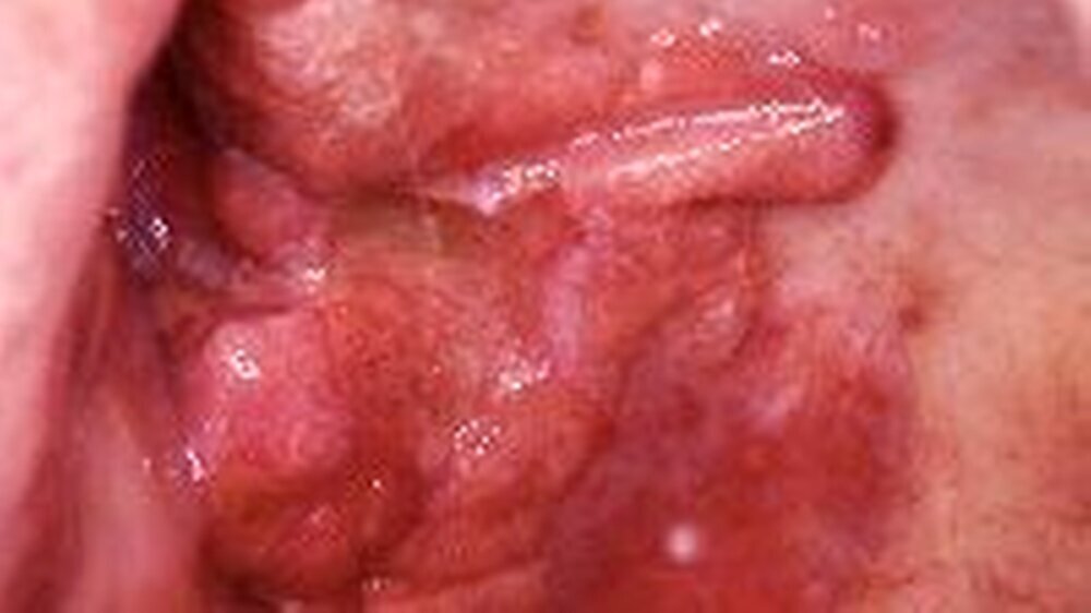 Abbildung 1: Klinischer Aspekt des Tumors. Es handelt sich um eine zentral ulzerierte Läsion mit aufgeworfenen, teilweise unregelmäßig nodulär konfigurierten Rändern.