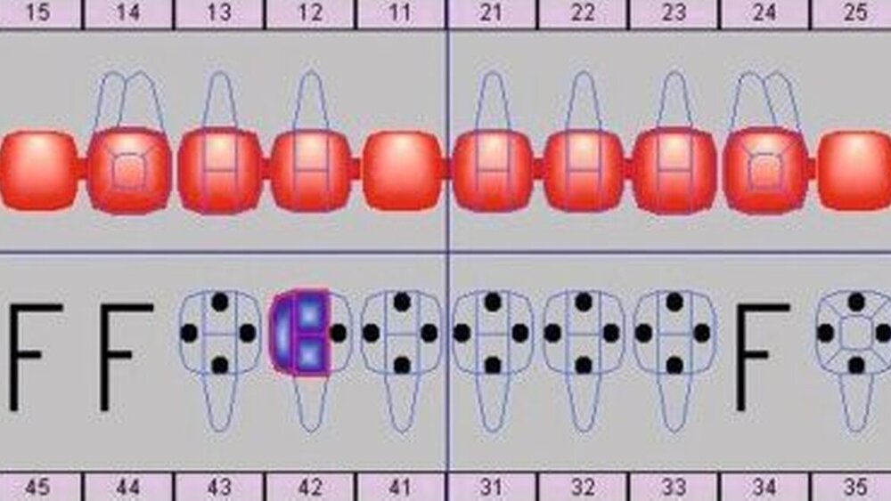 Abbildung 4: Schematisierter, grafischer Ausgangsbefund (HighDent Plus, Systema Deutschland GmbH). |