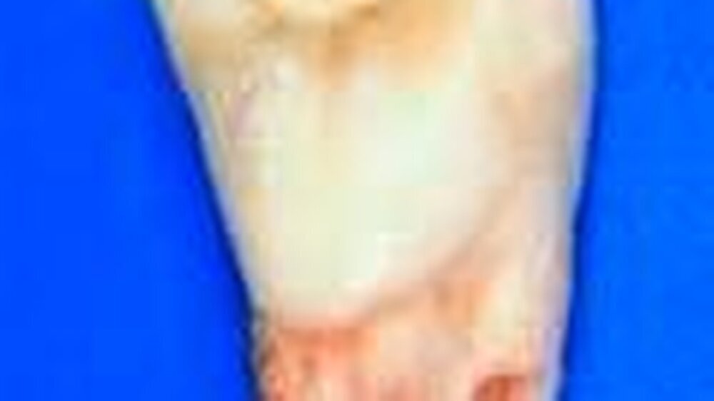 Abb. 1: Nahezu vollständige Resorption des Zahnes 11 nach Totalluxation mit trockener Lagerung vor der Replantation.