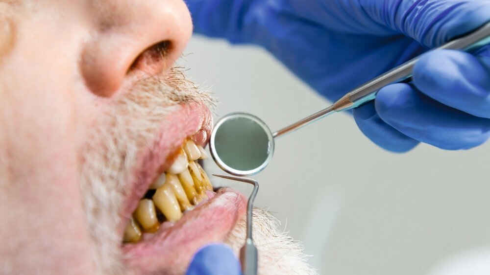 Bad teeth and mouth mirror. Dental examination close up.