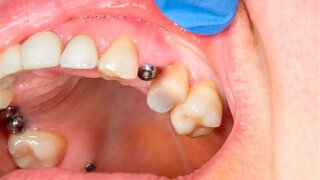 Nahaufnahme eines Patienten mit Zahnimplantat in einer Zahnklinik während der Behandlung