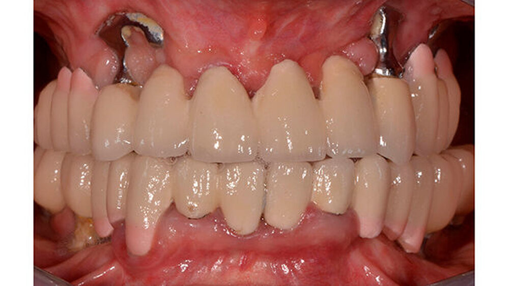 Lernkurven der Implantologie: Subperiostales Implantat