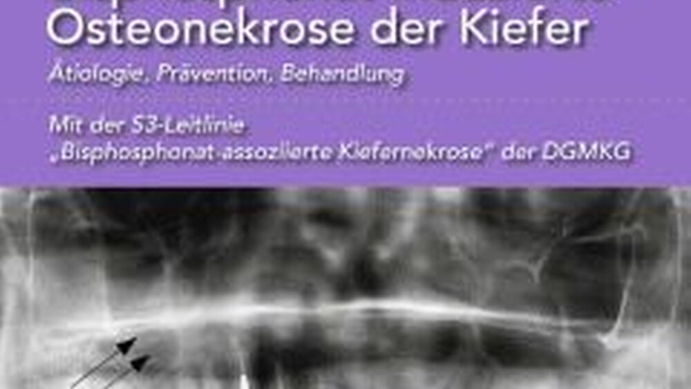Robert E. Marx: Bisphosphonat-induzierte Osteonekrose der Kiefer. Ätiologie, Prävention, Behandlung. Mit der S3-Leitlinie „Bisphosphonat-assoziierte Kiefernekrose“ der DGMKG. ISBN: 978-3-86867-107-0 88,00 Euro |