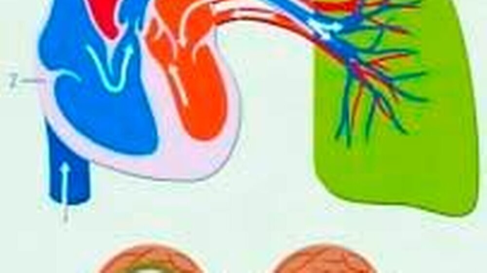 Abb. 1: Folgen der pulmonalen arteriellen Hypertonie (PAH): Erhöhung des Widerstandes in den Lungengefäßen (1) und Hypertrophie des rechten Ventrikels (2) sowie der Gefäße. (Quelle: Actelion, 2002)