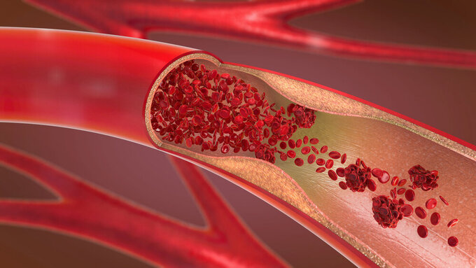 3d illustration of a constricted and narrowed artery and the blood cannot flow properly called arteriosclerosis Blutwerte
