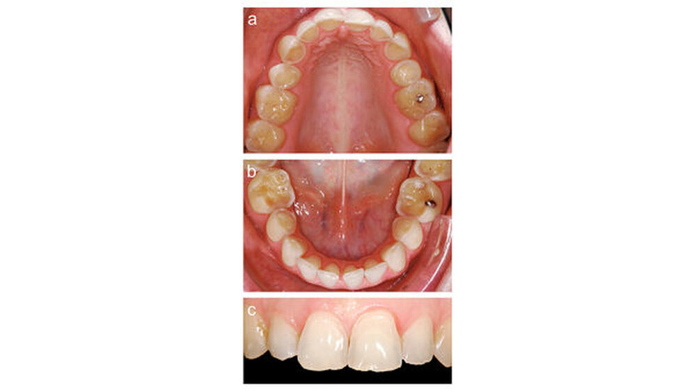 Abbildung 1: Ausgangsbilder vor der Behandlung: a: Oberkiefer, b: Unterkiefer, c: Frontzahnsituation |