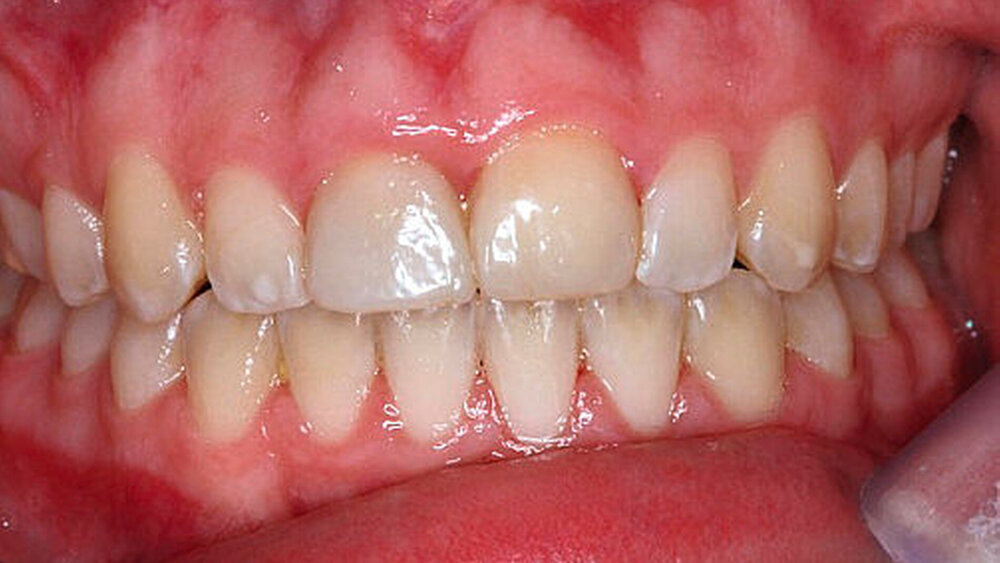 c: Befund dreieinhalb Jahre nach autoTX 15 nach 11: Es zeigt sich im Röntgenbild eine Wurzelobliteration des Transplantats in regio 11, was als vitales Zeichen betrachtet werden kann. Die kieferorthopädische Bewegung des Zahnes ist inzwischen abgeschlossen, es findet sich ein leichter Gewebeüberschuss an Zahn 11 im Vergleich zum gesunden Nachbarzahn 21. Die Zahnkrone am Transplantat 11 wurde zwischenzeitlich in kunststoffadhäsiver Technik aufgebaut. Der kieferorthopädische Lückenschluss im Bereich der Entnahmestelle regio 15 ist erfolgt. |