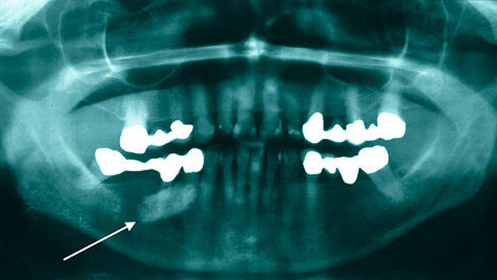 Abbildung 1: Alio loco angefertigte Orthopantomografie: röntgendichte Struktur rechter unterer Quadrant, am ehesten im Bereich des Mundbodens |