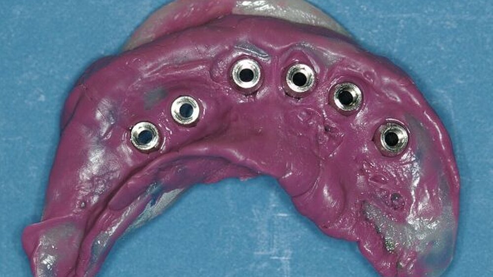 Abbildung 8: offene Implantatabformung (Aquasil Monophase, Dentsply) mit individuellem Löffel im Unterkiefer. |
