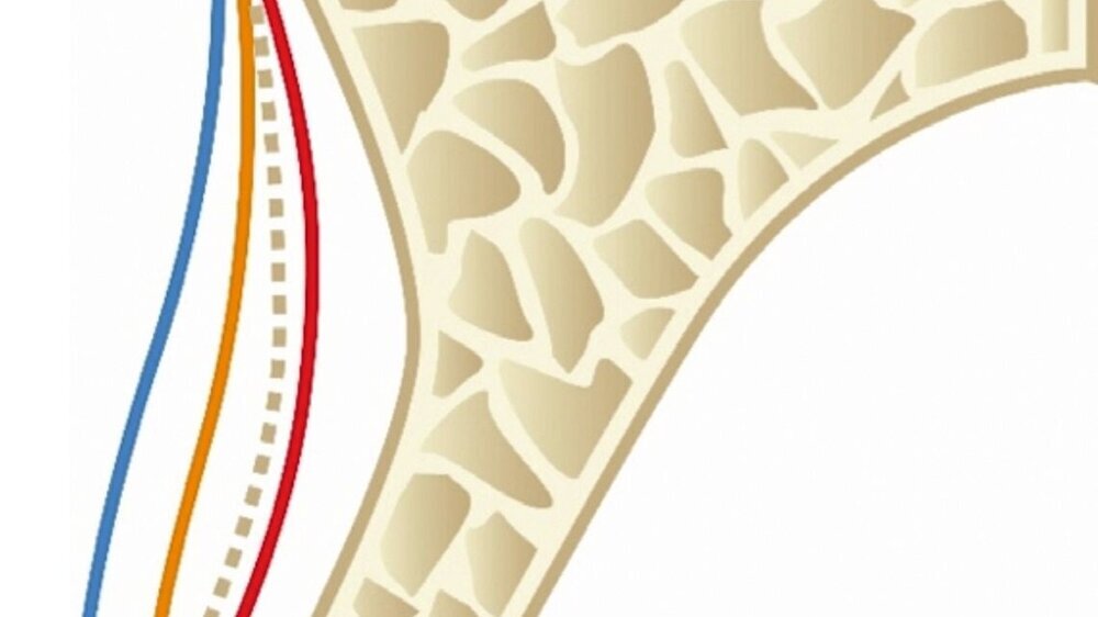 Resorption nach lateraler Augmentation mittels GBR
