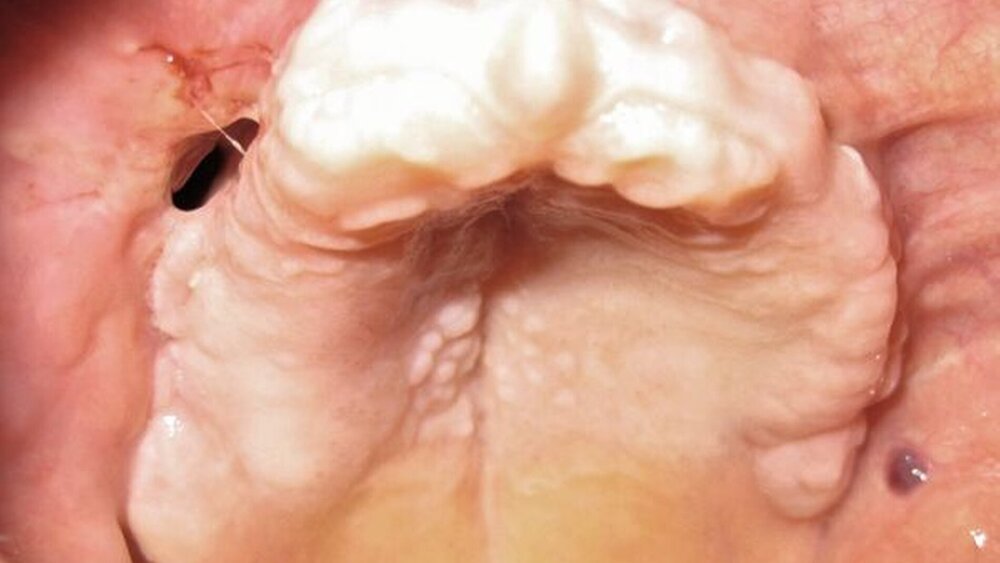 Abbildung 6: Zwei Wochen nach OP mit einer MAV in Regio 14: Es erfolgte eine plastische Deckung. |