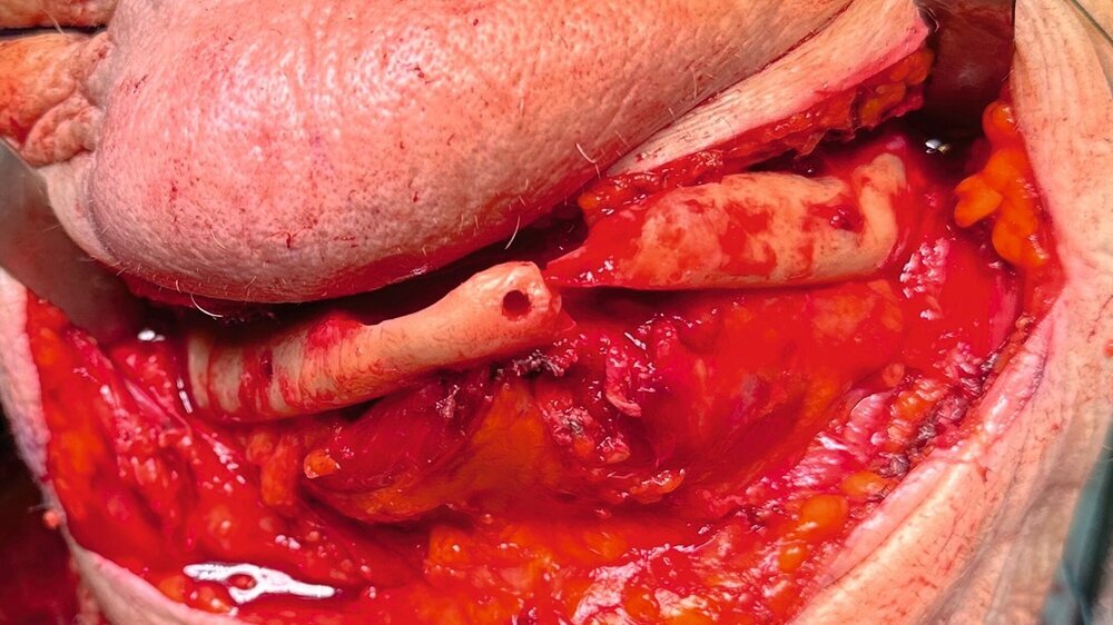 Abb. 5: Intraoperativer Situs nach Explantation der Unterkieferimplantate: Nach submandibulärem Zugang und Entfernung der Implantate im Unterkiefer stellt sich die Fraktur in regio 33 dar.