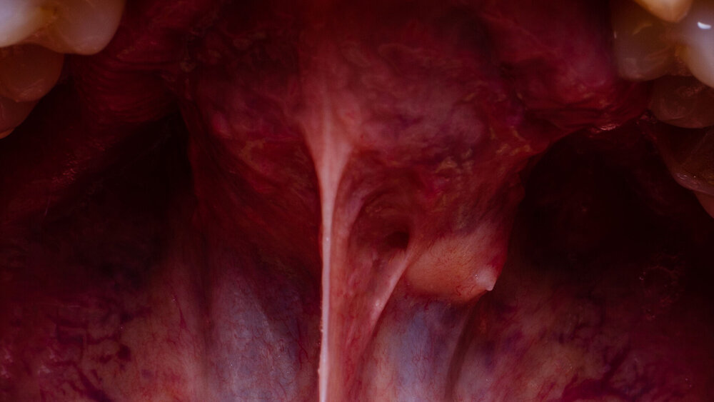 A tumor in the oral cavity of an adult, close-up. dental problems.