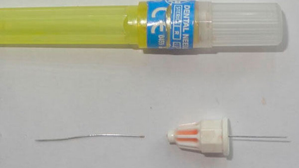 Der N. alveolaris inferior wurde hierbei penibel geschont. Nach klinischer Überwachung konnte der Patient die Klinik im beschwerdefreien Zustand verlassen.