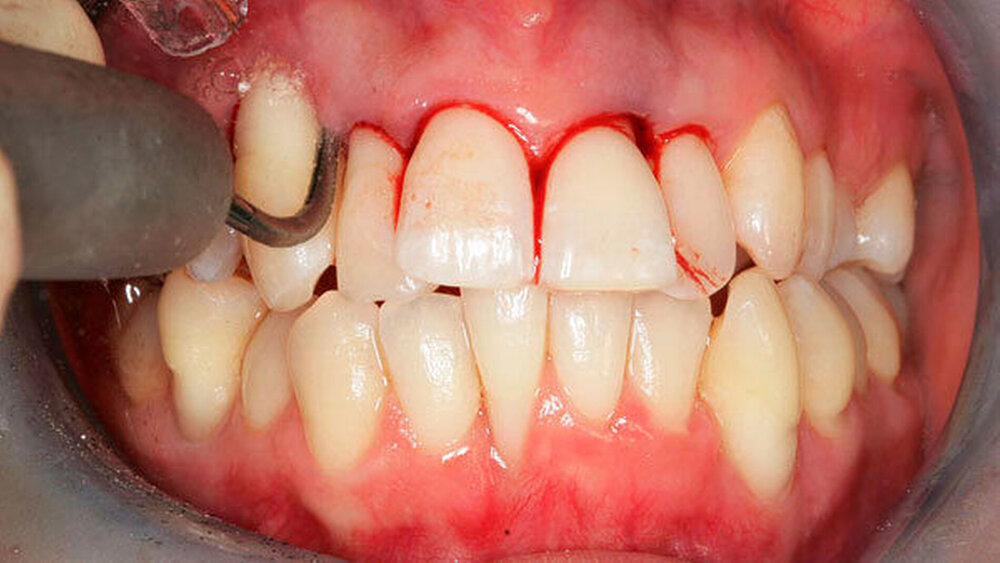 Parodontitistherapie mit unterschiedlicher Instrumentierung: b) Ultraschallscaler |