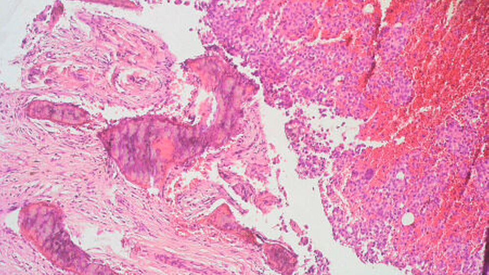 Abbildung 5: CD-1a positive immunhistochemische Färbung (400 x) |
