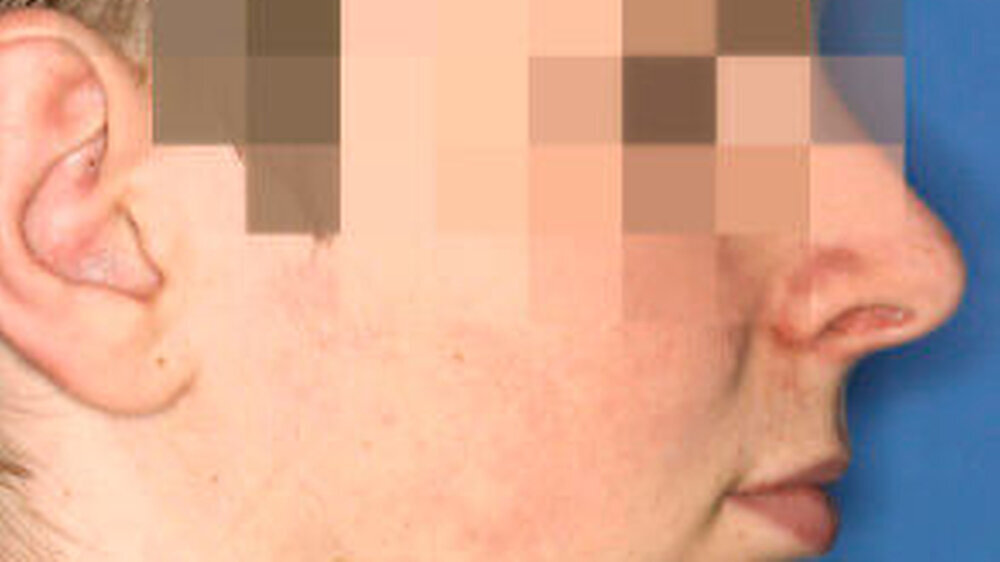 Abbildung 1: Profilaufnahme des 15-jährigen Patienten