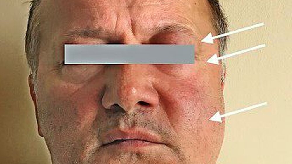 Abbildung 1b: Klinisches Bild Fall 1: Frontale Aufnahme mit sichtbarer Schwellung zervikofazial und im Bereich des Augenlids links. |