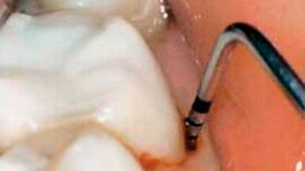 Abbildung 1: Klinische Ausgangslage; Zahn 36 mit Parodontal-Sonde (bukkal: 12 mm Sondierungstiefe)