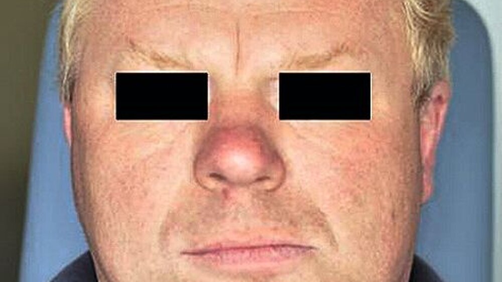Abbildung 1: Gesichtsasymmetrie mit Abweichung des Unterkiefers nach links