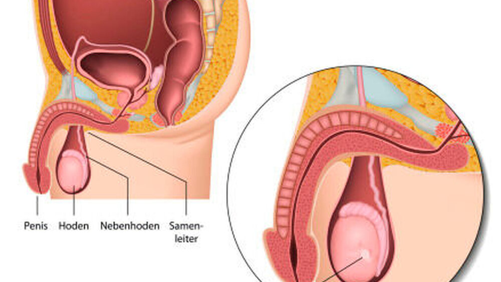 Hodentumore sind insgesamt seltene Tumore, bei jungen Männern allerdings die häufigste Krebserkrankung. |