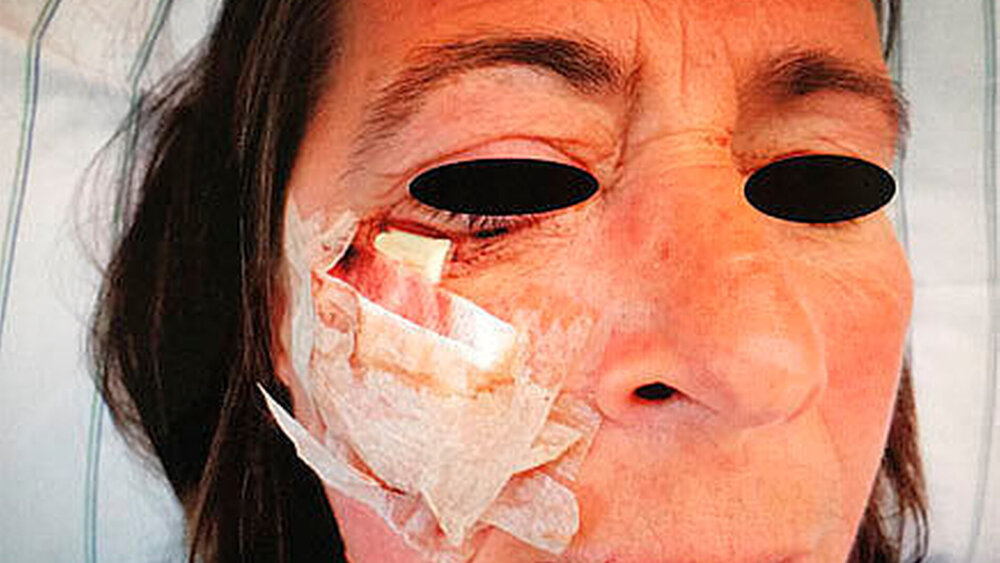 Abbildung 6: Postoperative Situation mit in situ befindlicher Drainage subziliär. Der Exophthalmus, die Chemosis sowie die Ober- und Unterlidschwellung sind schon ab dem ersten postoperativen Tag deutlich rückläufig. |