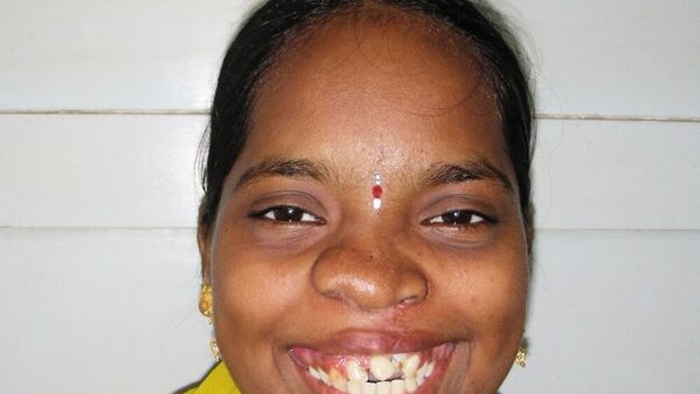 Abbildung 8: Frontalansicht sechs Monate postoperativ: Die Patientin ist mit der Gesamtsituation sehr zufrieden. Bis zur vollständigen Rehabilitation ständen zwei Operationen und eine anschließende kieferorthopädische Behandlung noch aus. |