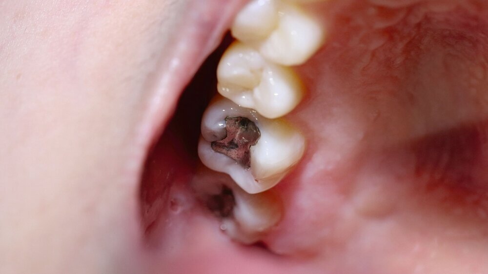 Zahnhöhle mit der Behandlung: Amalgam-Füllung Zahnhöhle mit der Behandlung: Amalgam-Füllung