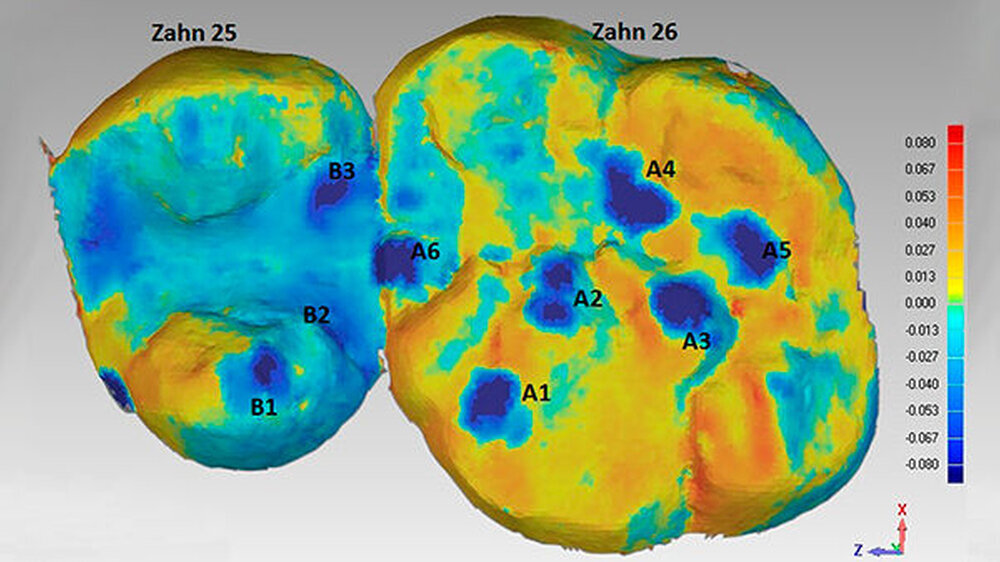 Überlagerung von zwei intraoralen, digitalen Abformungen, die zu unterschiedlichen Zeitpunkten erfasst wurden. Die morphologischen Unterschiede auf den Kauflächen sind farbcodiert. Die dunkelblauen Areale zeigen die Bereiche mit einem erhöhten, vertika