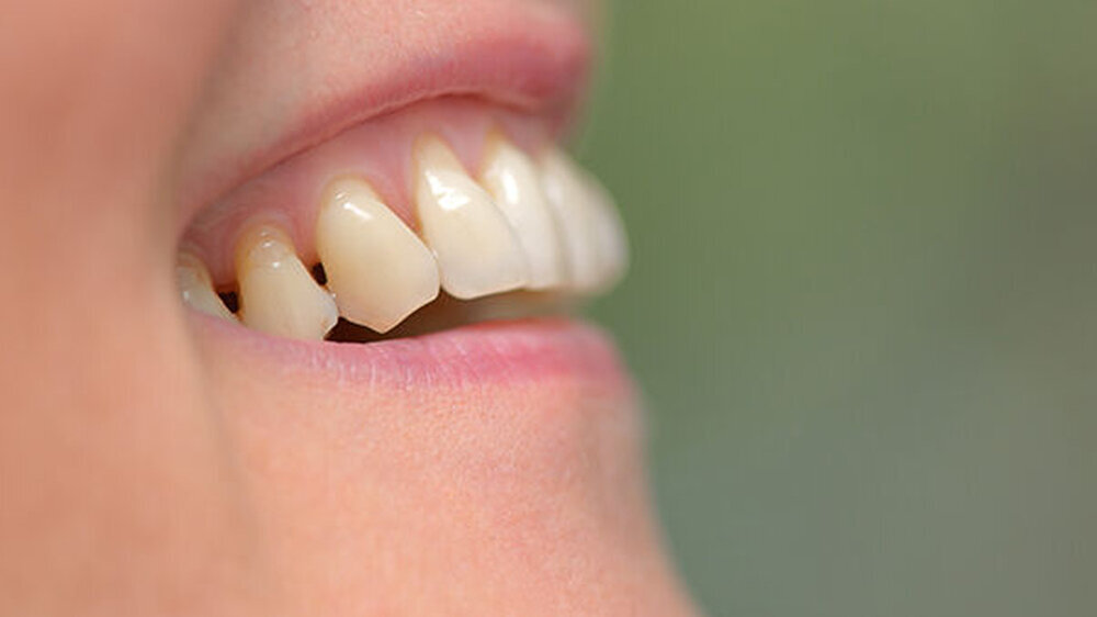 Könnte durch die Beseitigung von Gingivitis der Übergang in eine Parodontitis verhindert werden, würden sich die Kosten mit 11,8 Milliarden Euro langfristig nahezu halbieren.