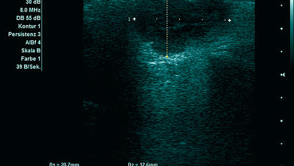 Abbildung 2: Sonografischer Befund: Echoarme Raumforderung mit dorsaler Schallverstärkung in der linken Glandula parotis |