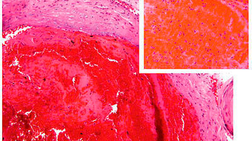 Abbildung 3: Ein roter Thrombus enthält sehr viele Erythrozyten, die von einem nur lockeren Fibrinnetz gehalten werden. Das Überwiegen der Erythrozyten bewirkt die rote Färbung des Thrombus, durch den relativ geringen Gehalt an Fibrin ist der Thrombus recht weich und kann sich leichter wieder auflösen. |