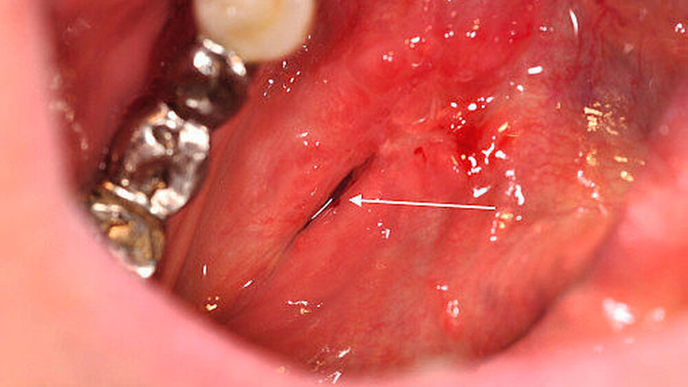Abbildung 7:  Klinisches Bild bei der Nachsorge am 20. Tag postoperativ: Der weiße Pfeil markiert den neu gebildeten Ausführungsgang nach Marsupialisation mit regelrechtem Speichelaustritt. |