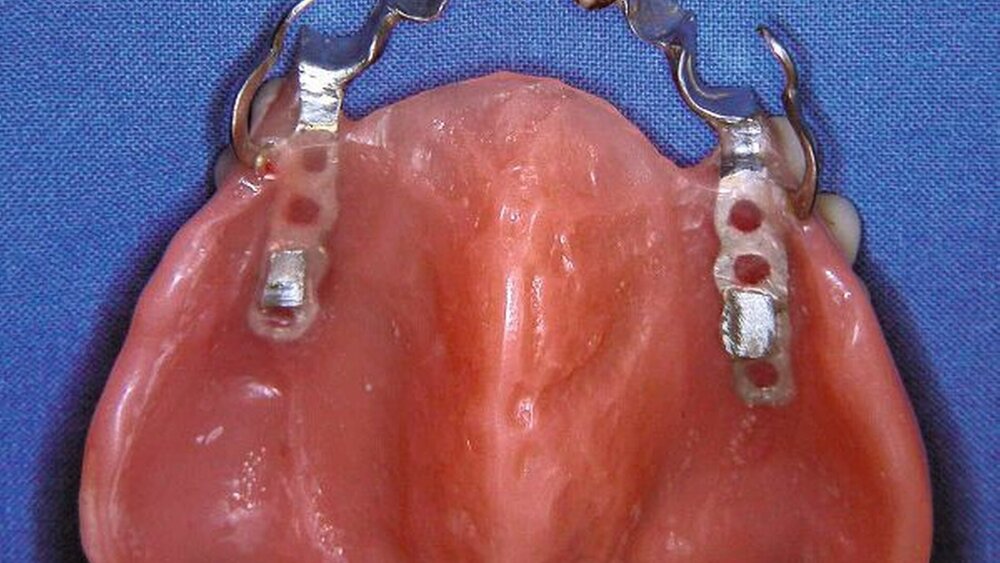 Herausnehmbarer Zahnersatz kann durch einen dentalen Verbinder vorteilhaft erweitert werden, behelfsweise auch unter Einbeziehung der ursprünglichen Zahnkrone. |