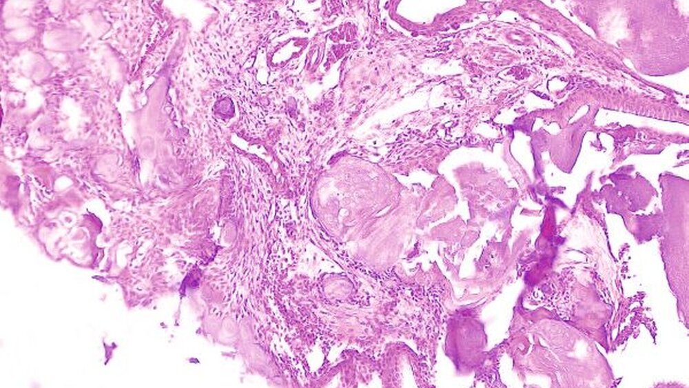 b) histologisches Bild des komplexen Odontoms: Auffällig sind Anteile von tubulärem Dentin, Schmelz und gefäßführendem Pulpagewebe. [Das histologische Präparat wurde freundlicherweise von Dr. med. Harald Ebhardt, Zentrum für Oralpathologie Potsdam, zur Verfügung gestellt.] |