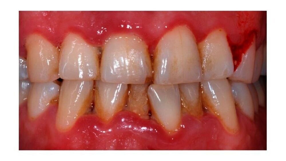 Nekrotisierende ulzerierende Gingivitis und nekrotisierende ulzerierende Parodontitis. Erfahren Sie mehr zu Zahnfleischerkrankungen und ihren Ursachen auf dem Haleon Healthpartner Portal.