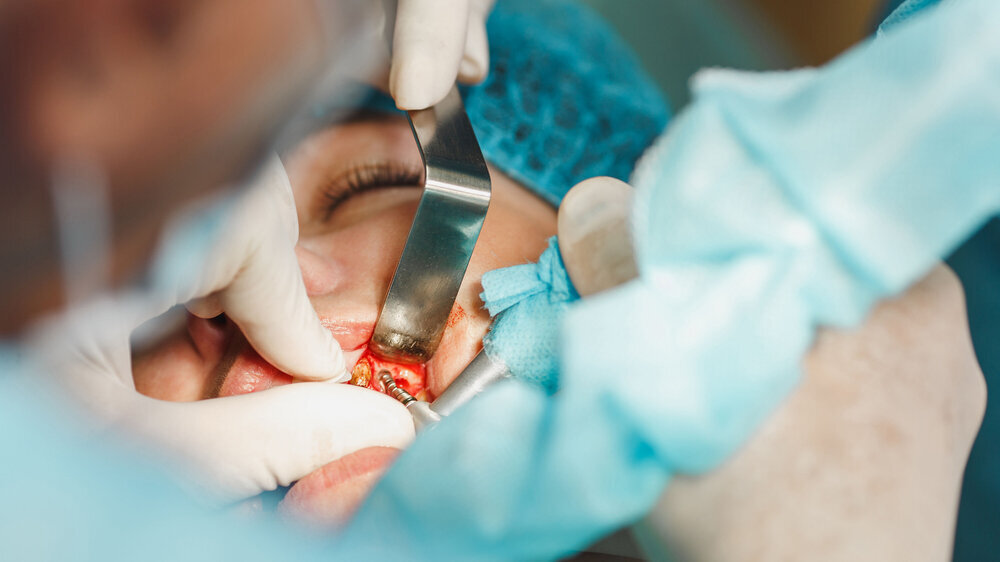 Antibiotika-Alternativen zu Amoxicillin könnten laut einer US-Studie in Verbindung mit vermehrten Verlustraten bei Implantationen stehen.