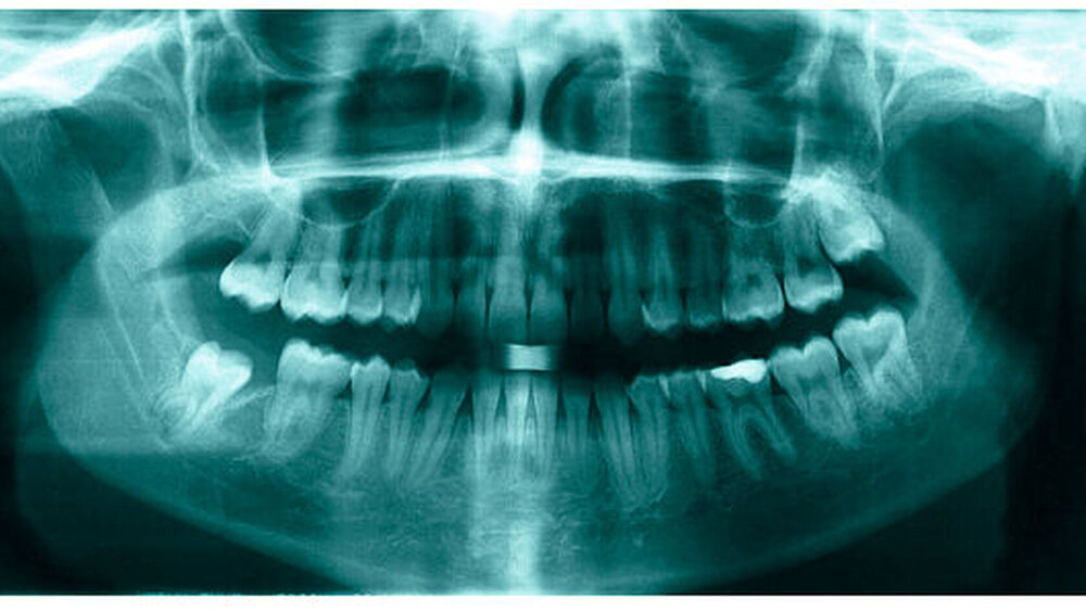 4b: OPG nach mehrjähriger funktionskieferorthopädischer Stimulation zeigt den remodellierten Kondylus rechts |