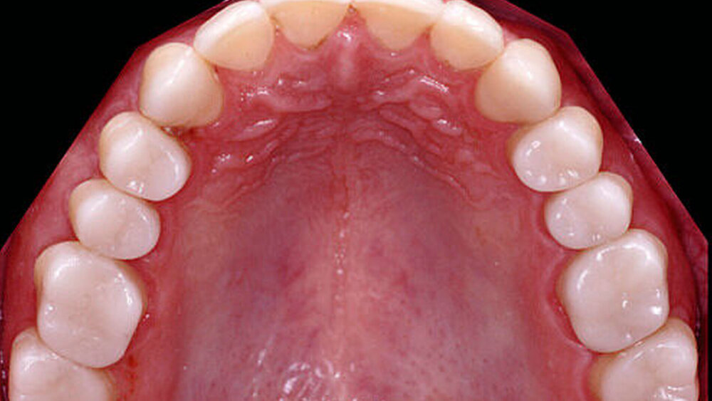 Abbildung 4: Langzeitprovisorische Versorgung: Situation nach adhäsiver Eingliederung von CAD/CAM-gefertigten PMMA-basierten Einzelzahnprovisorien aus CAD-Temp (Vita Zahnfabrik) |