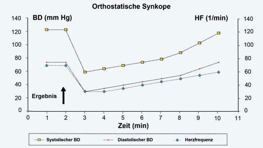 Bei dieser Form der kardiovaskulären Dysregulation wird ein meist langsamer Blutdruckabfall und Schrumpfung der Blutdruckamplitude bei gleichzeitigem Frequenzanstieg beobachtet. Die Patienten weisen weiterhin Zeichen der Zentralisation auf. Die auslösende Ursache (Pfeil) ist meist das plötzliche Aufstehen aus liegender Position. |