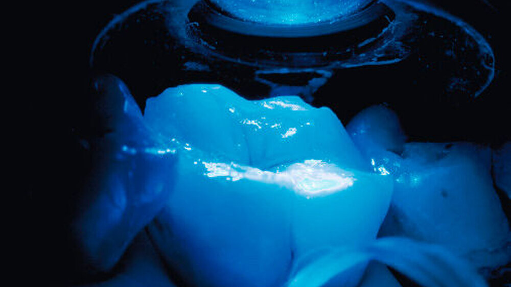 Hier wird die Lichthärtung gezeigt, wie sie nicht sein sollte: Der Lichtleiter ist nicht optimal über der Füllung platziert und müsste besser stabilisiert werden.