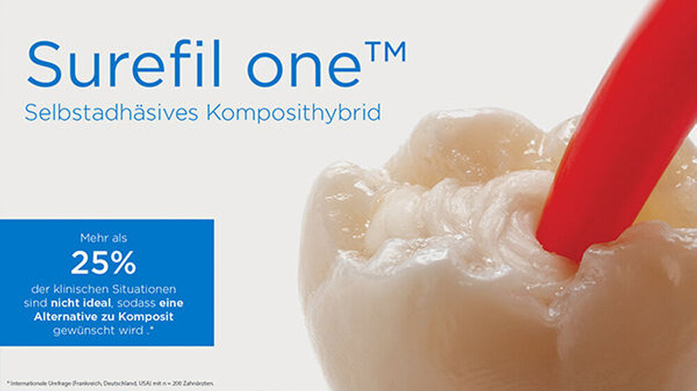 Kein Ätzen, kein Bonden, gestrichen, nicht gestopft: schnelle und sichere Füllung mit dem selbstadhäsiven Komposithybrid Surefil one (Dentsply Sirona).