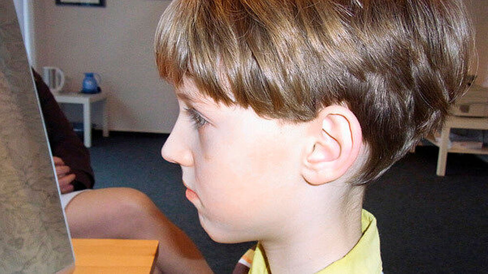 Abbildung 7: Ein Blick auf das Kopfprofil zeigt eine starke saggitale Stufe und somit eine Unterkieferrücklage. |