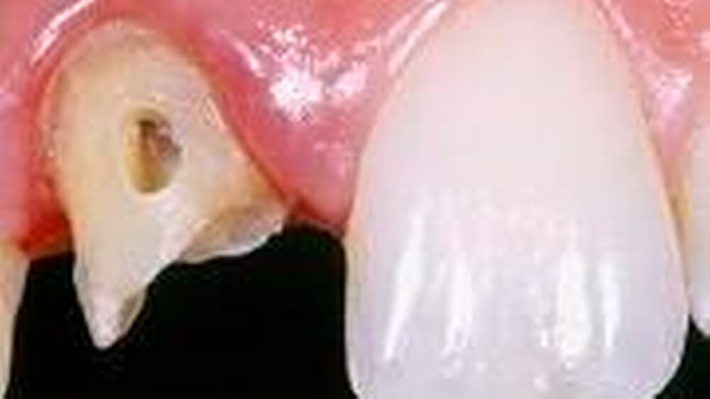 Abb. 1: Eine nach langjähriger Kronenversorgung vorangeschrittene Sekundärkaries erforderte eine endodontische Behandlung des Zahnes 11.