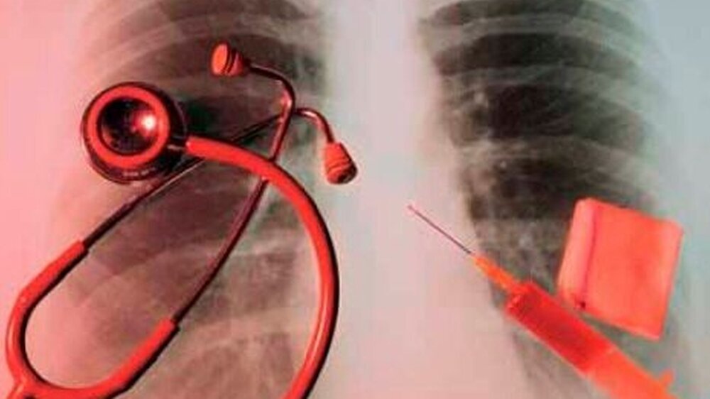 Oft liefert das Röntgenbild die erste Diagnose für Krebs in der Lunge. Erste Therapieansätze zeichnen sich\r\nab.