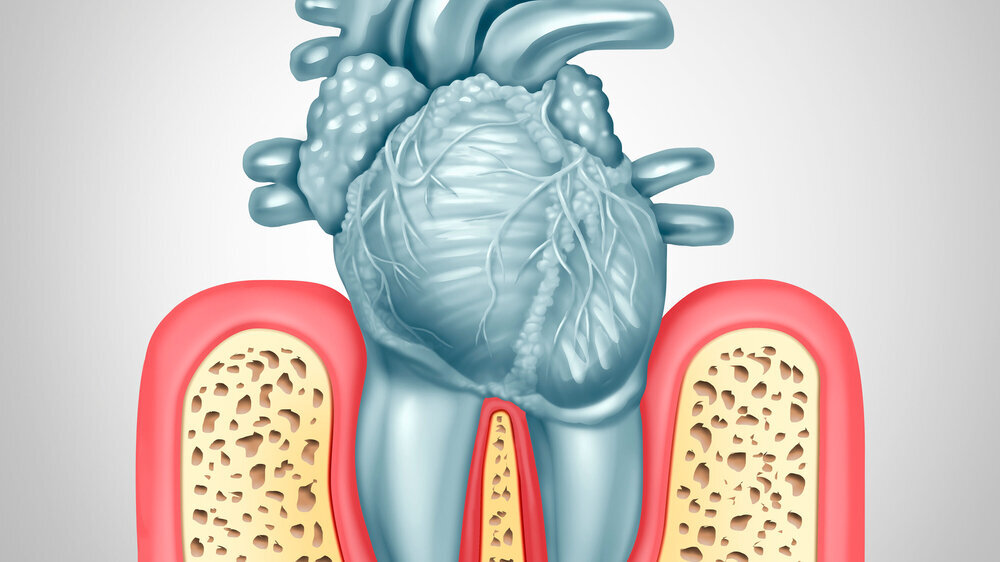 Parodontitis und Herzerkrankungen
