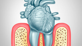 Parodontitis und Herzerkrankungen