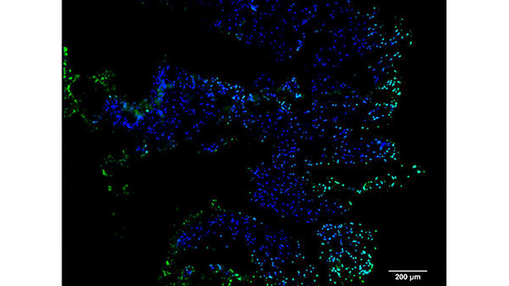 In einer Gewebeprobe, die mit Plasma behandelt worden ist, leuchten unter allen Tumorzellen (blaue Fluoreszenz) die durch Apoptose abgeschalteten Tumorzellen, die im Absterben befindlich sind, grün auf.\r\n